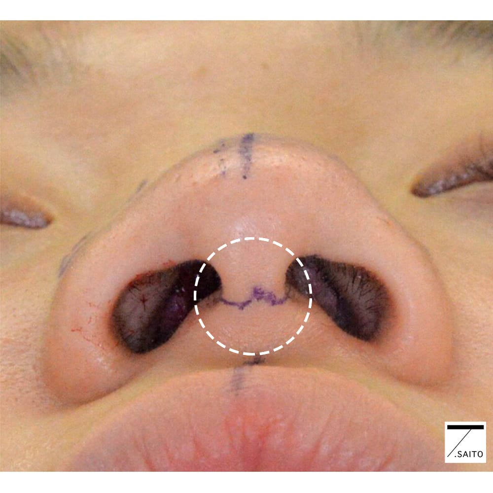 鼻の手術　切開デザイン