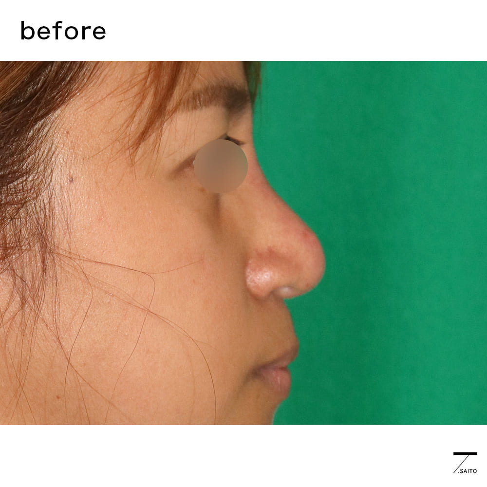 団子鼻には注入治療は効かない 丸い鼻先のお直し ３つの注意点 さいとう 齋藤 隆文 公式hp 美容外科医 形成外科専門医